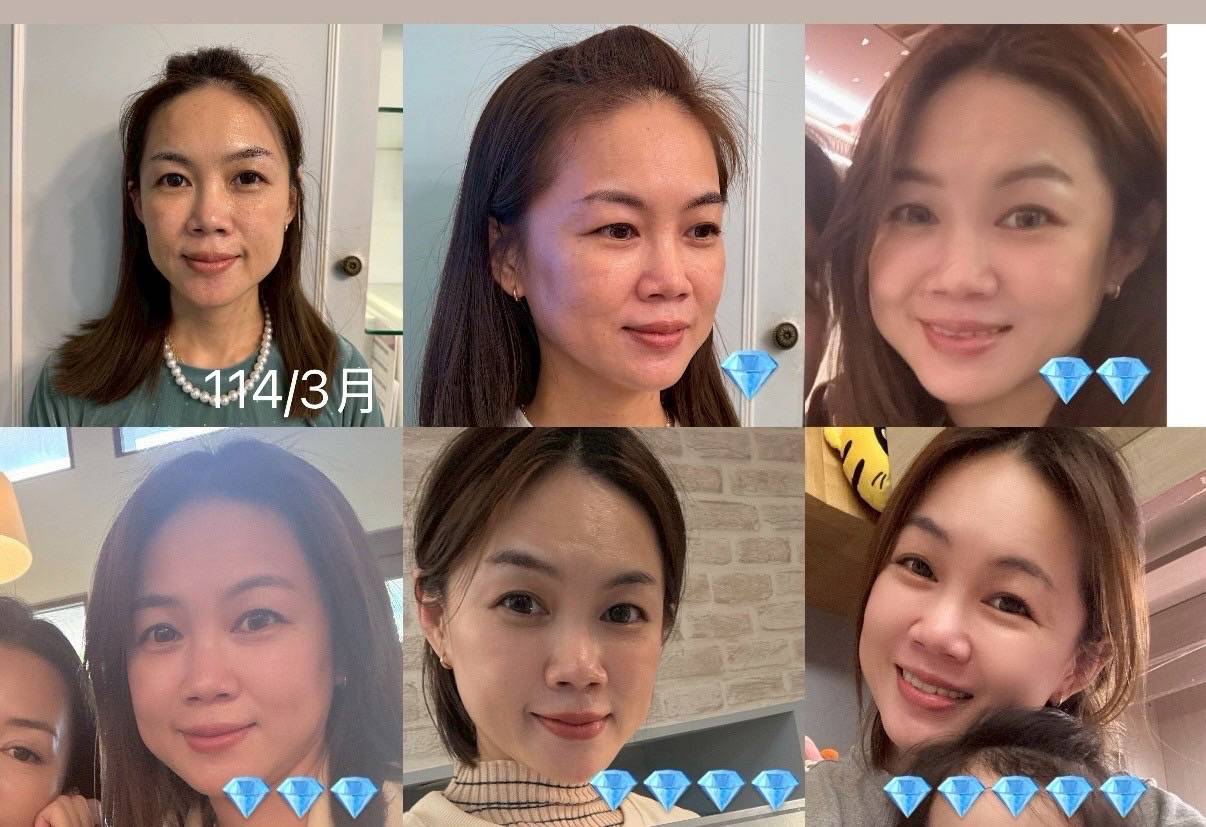 RENE CELL 潤尼秀 使用前後對比 真實肌膚蛻變見證